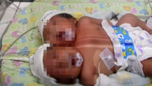 RS Hasan Sadikin Bandung Tangani Bayi Kembar Siam Berkaki Tiga