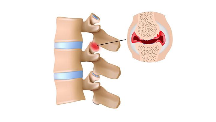 9 Major Causes of Arthritis
