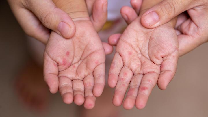 Sumenep Declares Measles Outbreak: 78,000 Children Targeted for Vaccination
