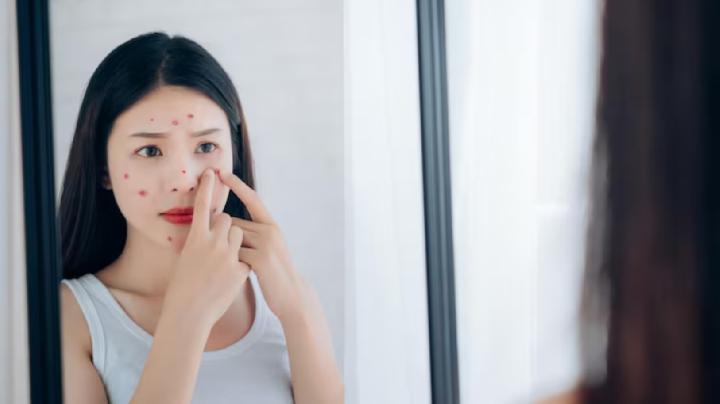 Solusi Perawatan Kulit Berjerawat dengan Acnes