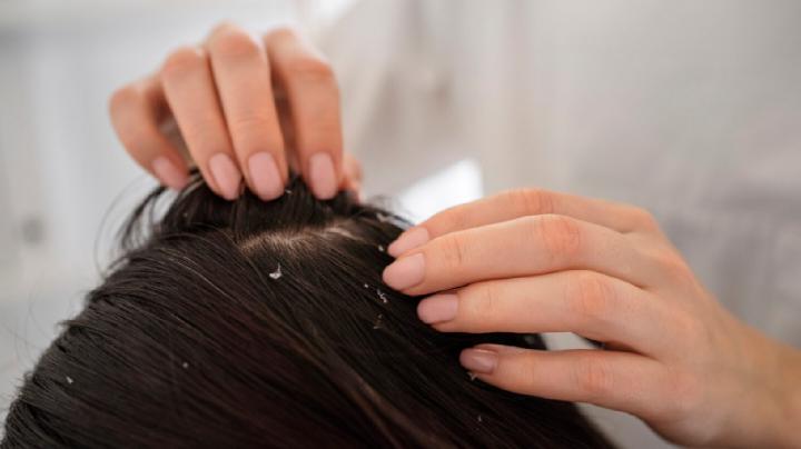 Kulit Kepala Bebas Gatal dan Ketombe dengan Selsun